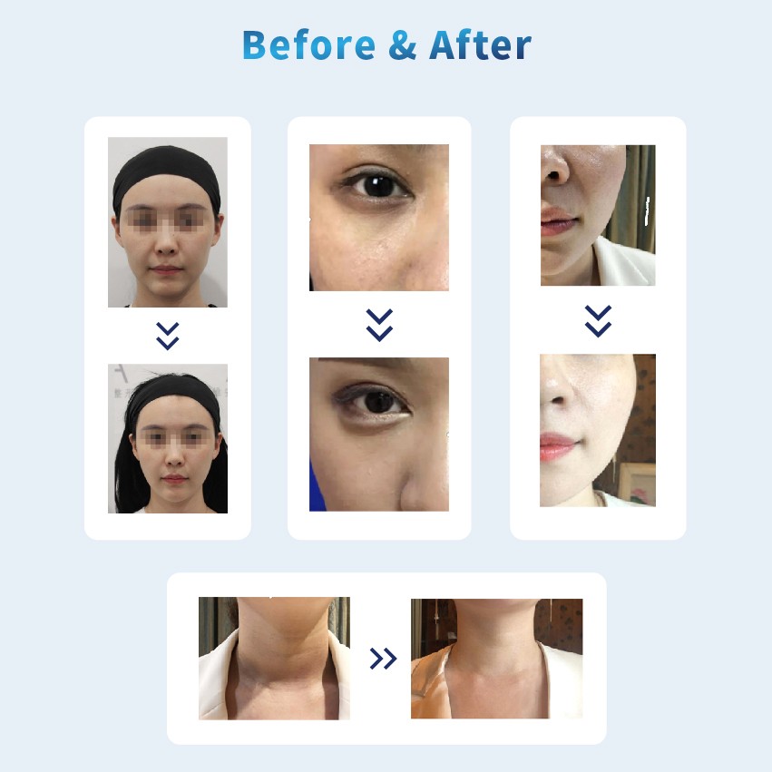 Plla Dermal Filler before after - Dermax