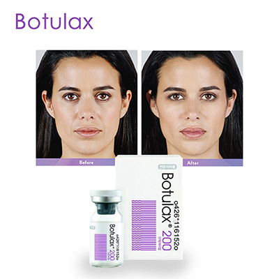 Botulinum Toxin for Perioral Lines or Smoker Lines